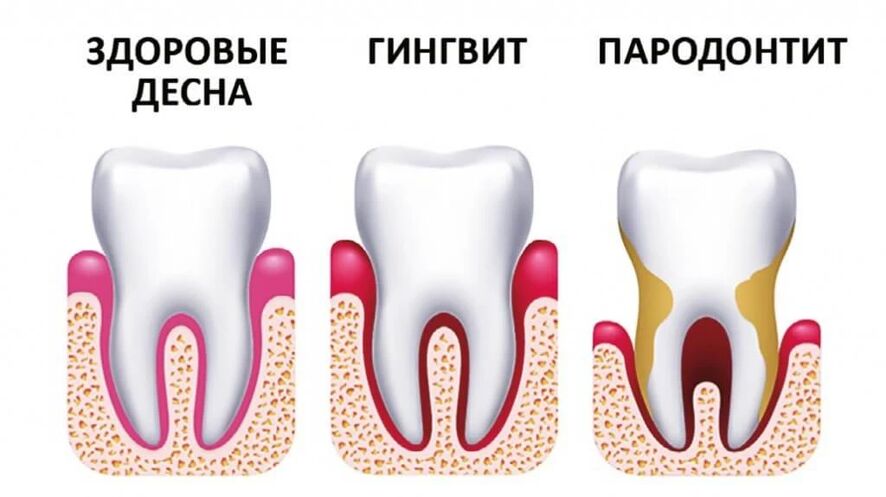 Лікування пародонтиту - стоматолог Чернівці