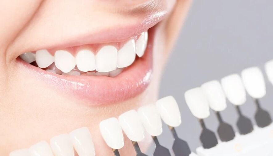 Вініри в Чернівцях (протезування) - стоматолог Анастасія